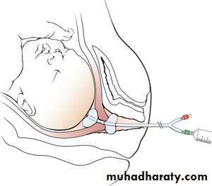 Induction of labour