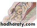 Multiple pregnancy
