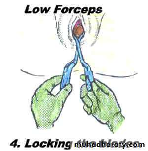 Obstetric procedures
