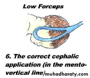 Obstetric procedures