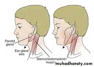 MUMPS MEASLES RUBELLA