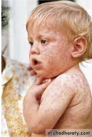 MUMPS MEASLES RUBELLA
