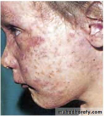 MUMPS MEASLES RUBELLA
