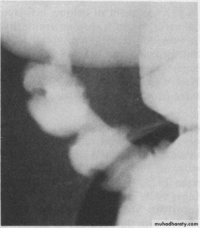 Small bowel