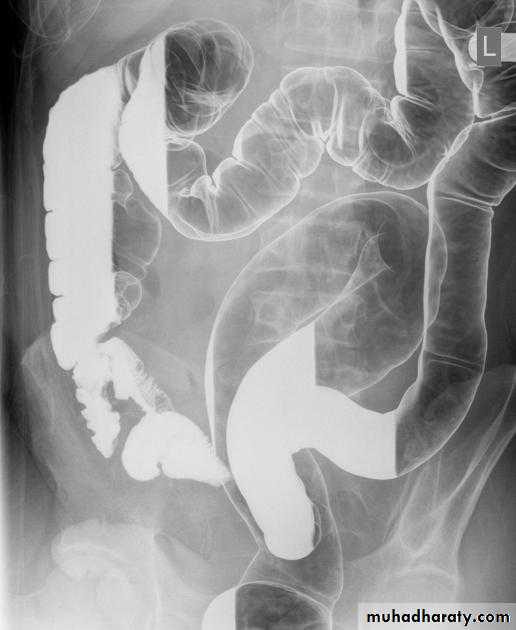 Small bowel