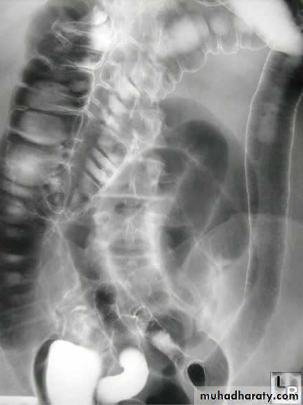 Small bowel