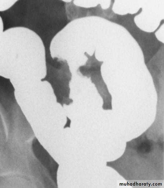 Small bowel
