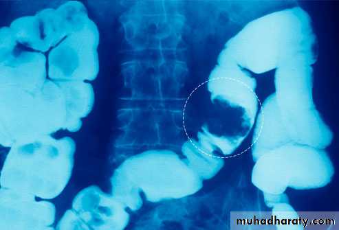 Small bowel