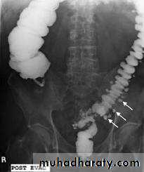 Small bowel