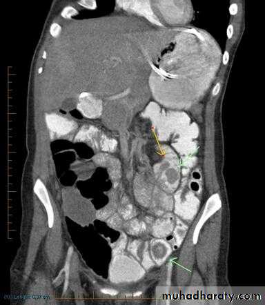 Small bowel