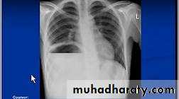 Small bowel