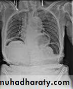 Small bowel