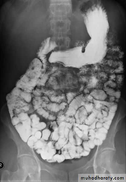 Small bowel