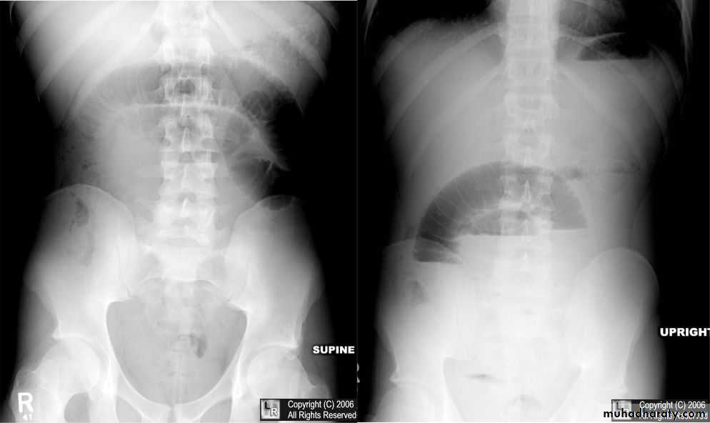 Small bowel