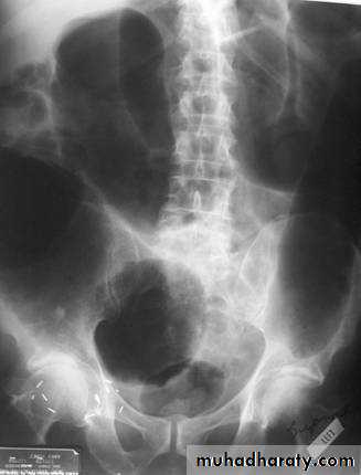 Small bowel