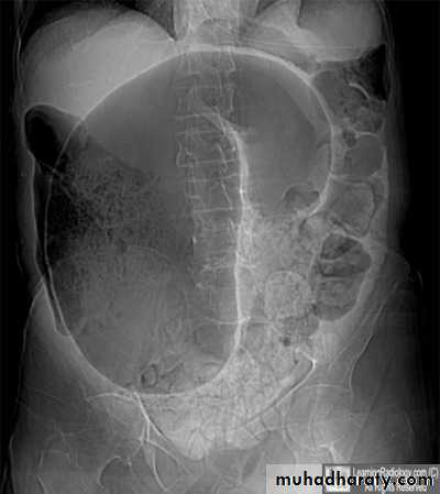 Small bowel