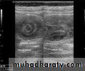 Small bowel