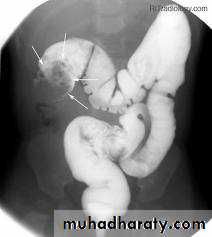 Small bowel