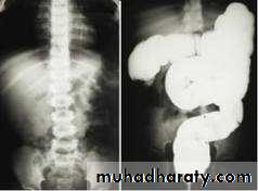 Small bowel