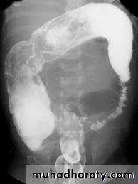 Small bowel