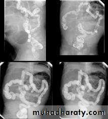 Small bowel