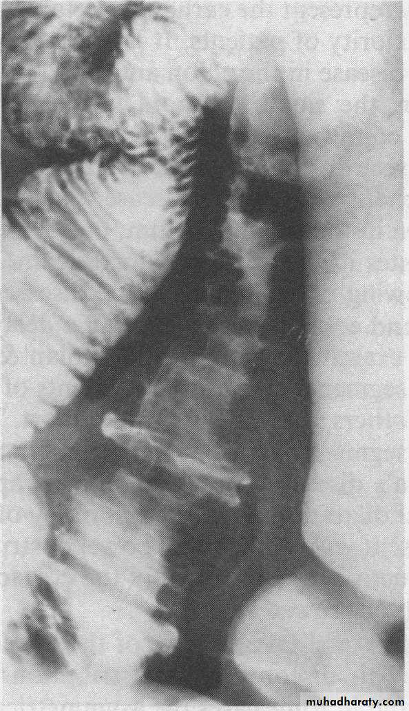 Small bowel