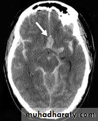 vascular neurosurgery