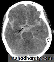 vascular neurosurgery
