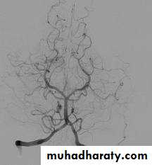vascular neurosurgery
