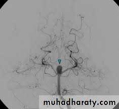 vascular neurosurgery