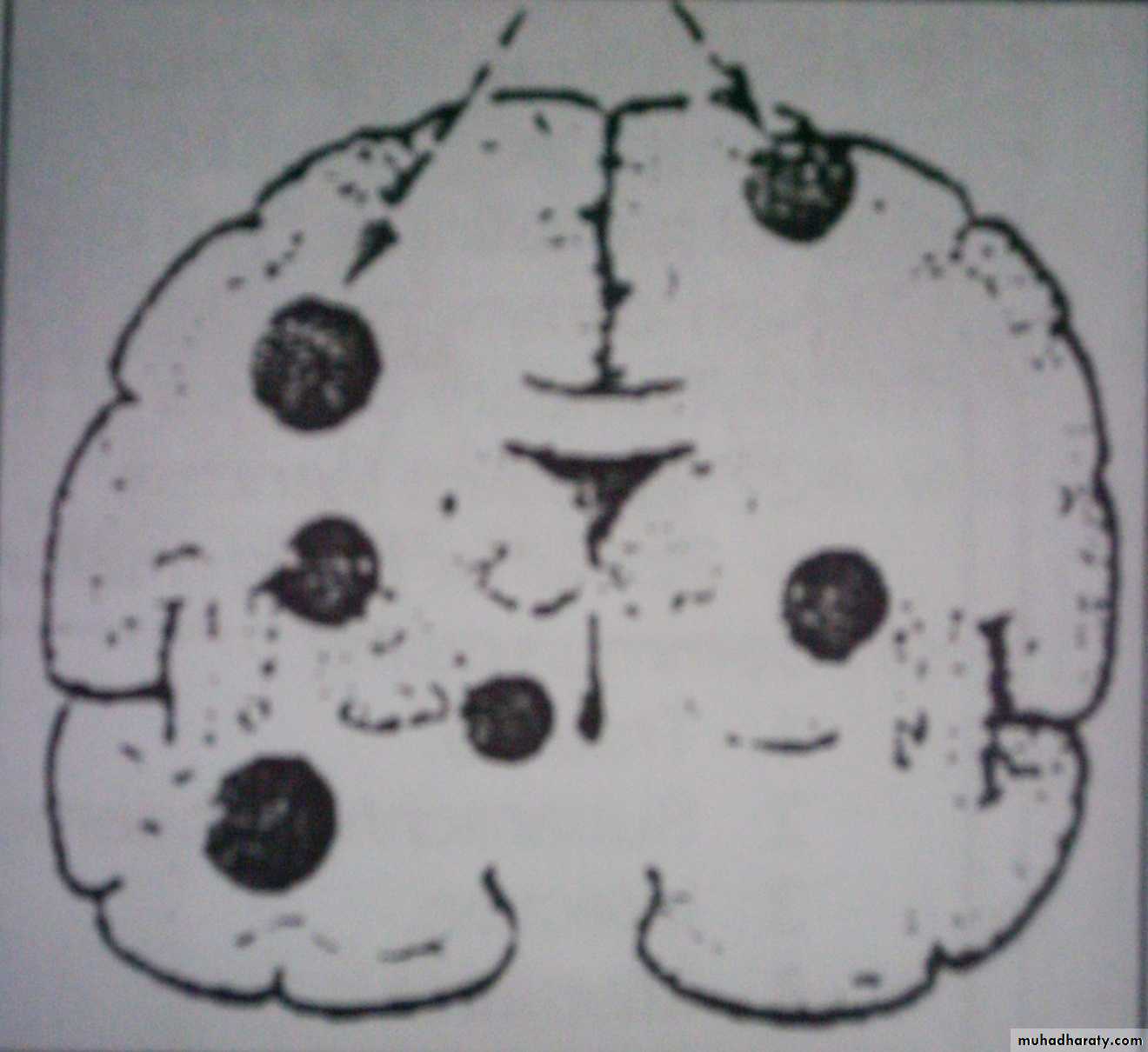 Intracranial Infection