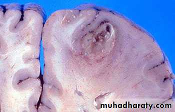 Intracranial Infection