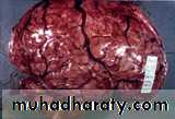 Intracranial Infection