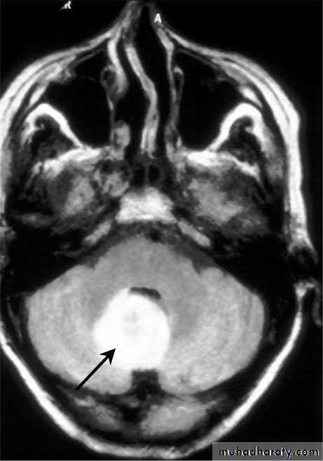 Intracranial Infection
