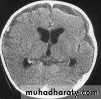Intracranial Infection