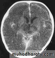 Intracranial Infection
