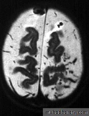 Intracranial Infection