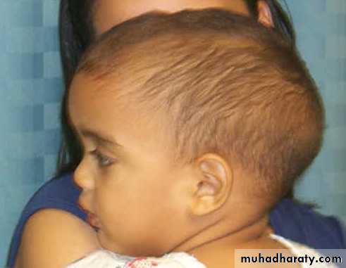 Developmental Abnormalities of the Nervous System