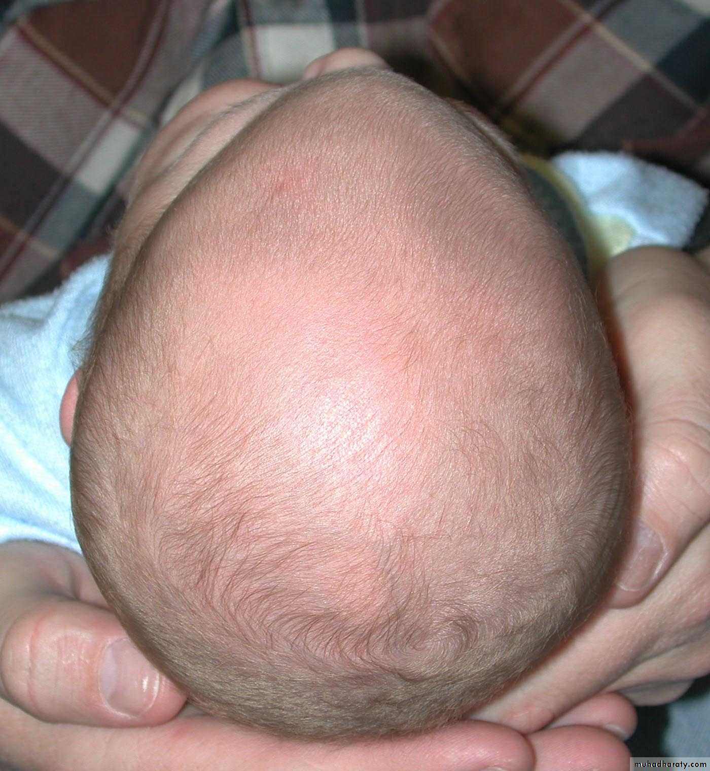 Developmental Abnormalities of the Nervous System