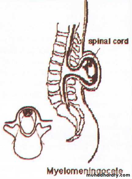 Developmental Abnormalities of the Nervous System