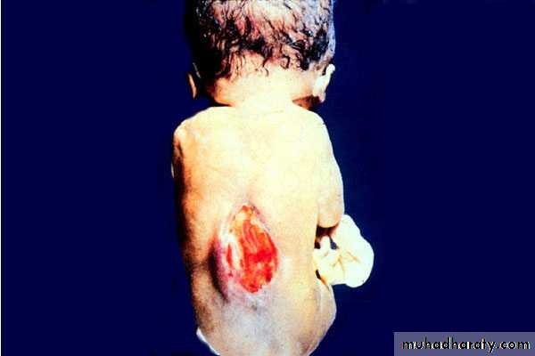 Developmental Abnormalities of the Nervous System