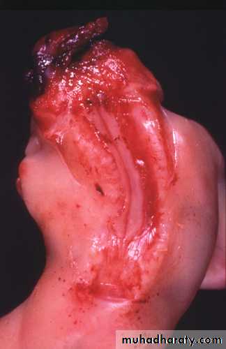 Developmental Abnormalities of the Nervous System