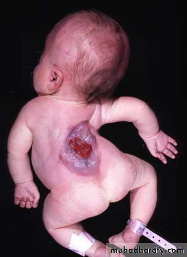 Developmental Abnormalities of the Nervous System