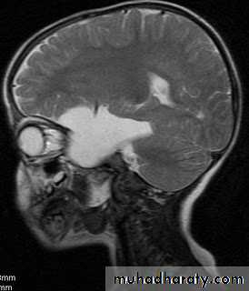 Developmental Abnormalities of the Nervous System