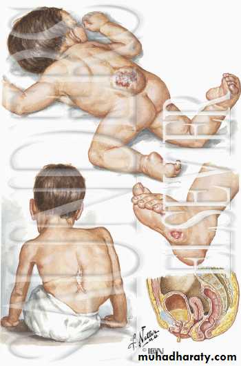 Developmental Abnormalities of the Nervous System