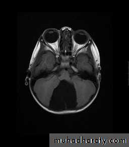 Developmental Abnormalities of the Nervous System