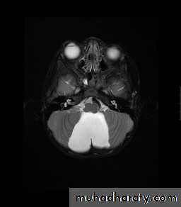 Developmental Abnormalities of the Nervous System