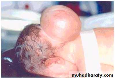 Developmental Abnormalities of the Nervous System