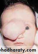 Developmental Abnormalities of the Nervous System