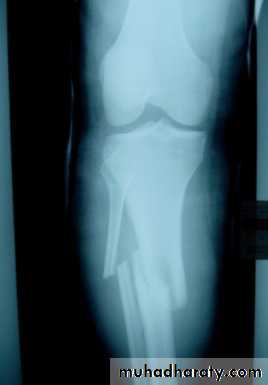 Fractures shaft tibia and fibula